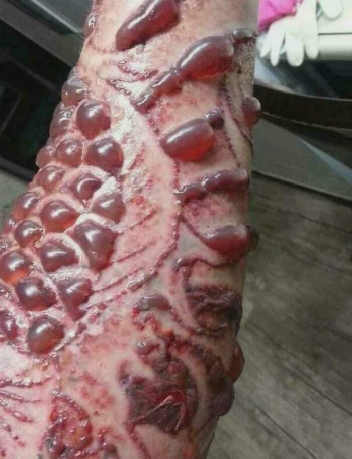 Close-up of a medical case showing severe, gory skin blisters and lesions on a patient's arm.