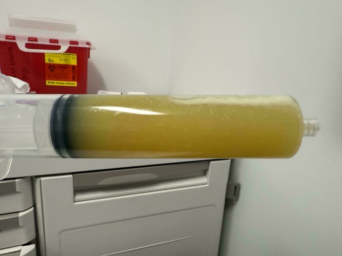 Thick yellowish fluid in a large syringe, part of unusual medical cases that are both gory and interesting.