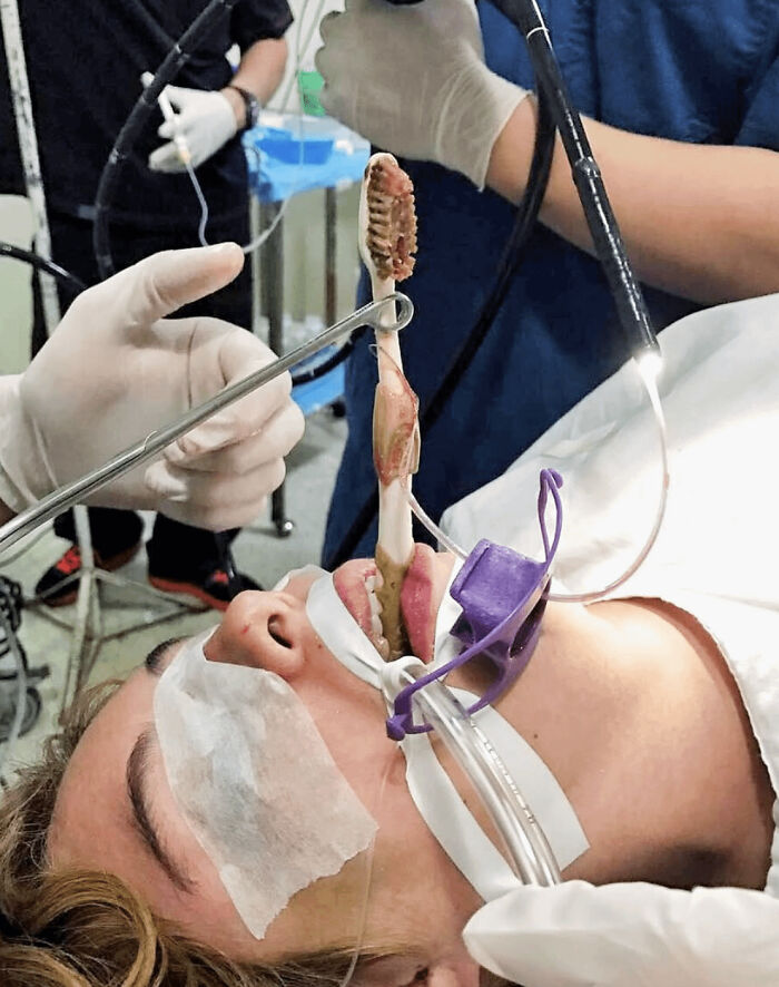 Medical case showing removal of a large parasitic worm from a patient's mouth during a surgical procedure.