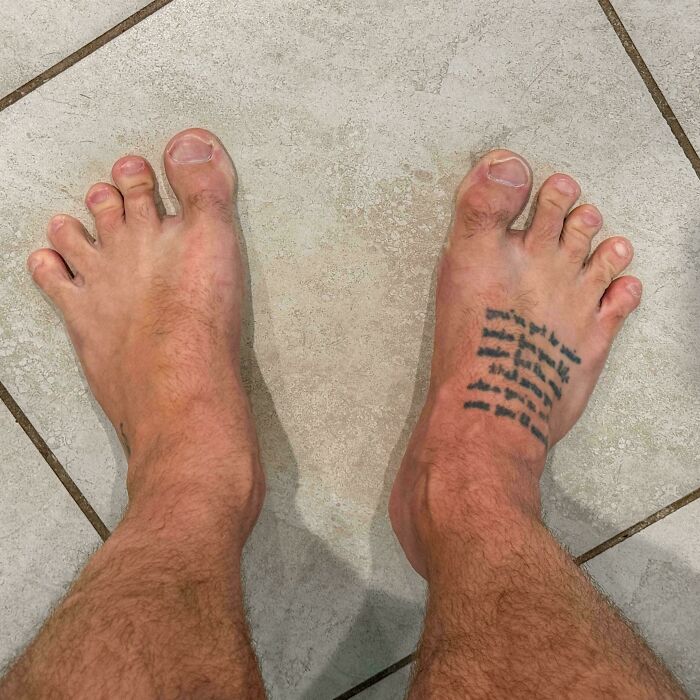 Swollen feet with visible deformities and tattoo, illustrating a medical case that is both gory and interesting.