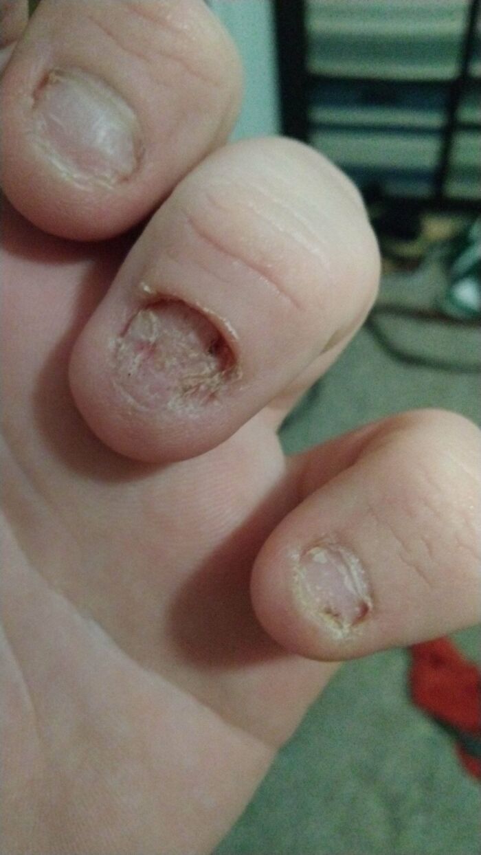 Close-up of fingers with damaged and partially missing nails showing a gory medical case affecting the skin and nail beds.