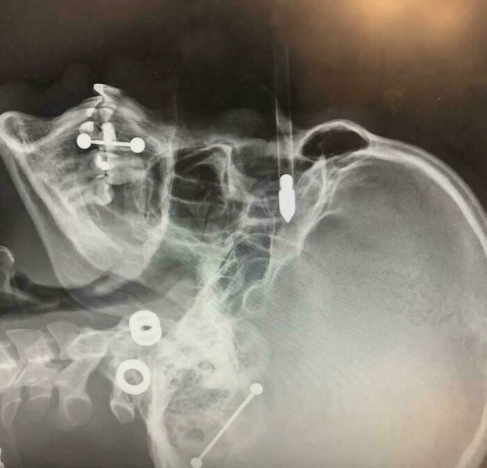 X-ray image showing medical case with skull fixation hardware and foreign objects, highlighting gory and interesting medical cases.