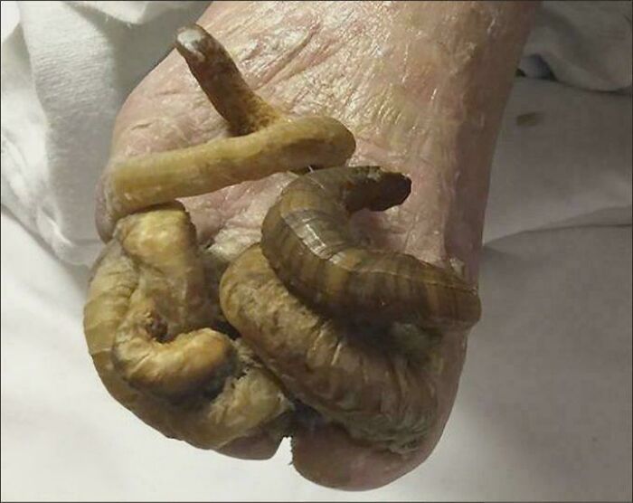 Severe medical case showing large parasitic larvae infestation causing deformation, illustrating gory and interesting medical conditions.