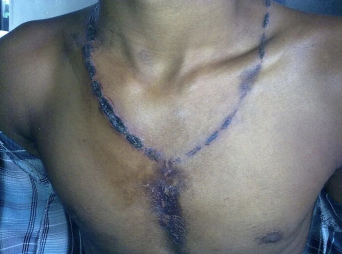 Close-up of a chest showing a healing scar from a medical case with gory and interesting wound patterns.