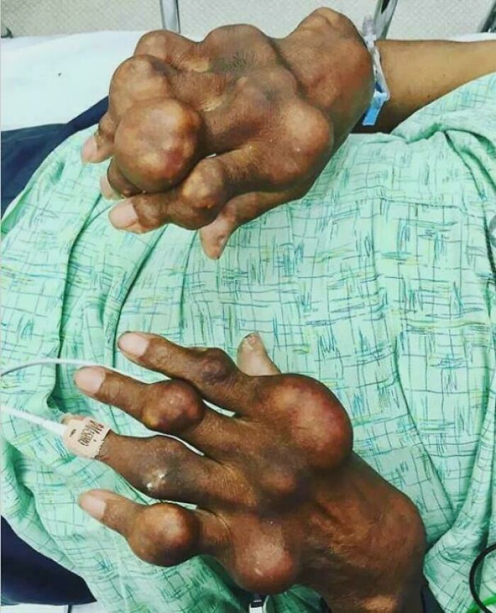 Severe medical case showing grotesque deformities and swelling of hands with multiple large growths in hospital setting.