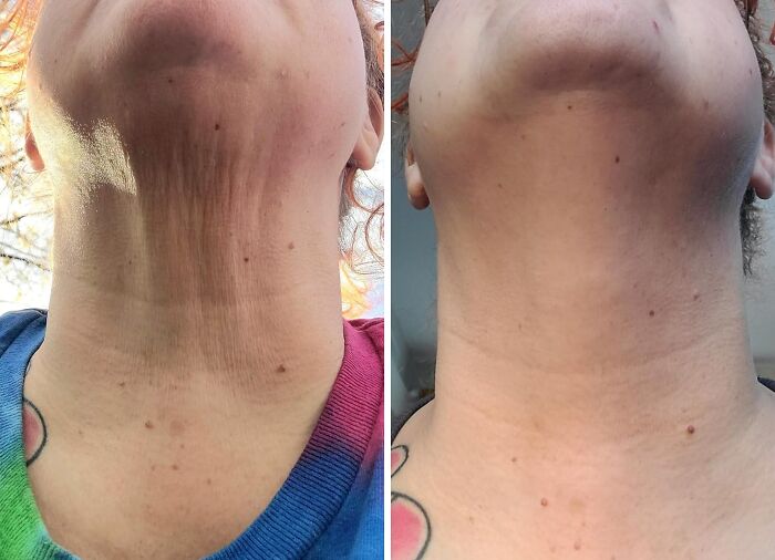 Before and after close-up of a neck showing skin improvement, illustrating genius ways to fix little skin glitches.