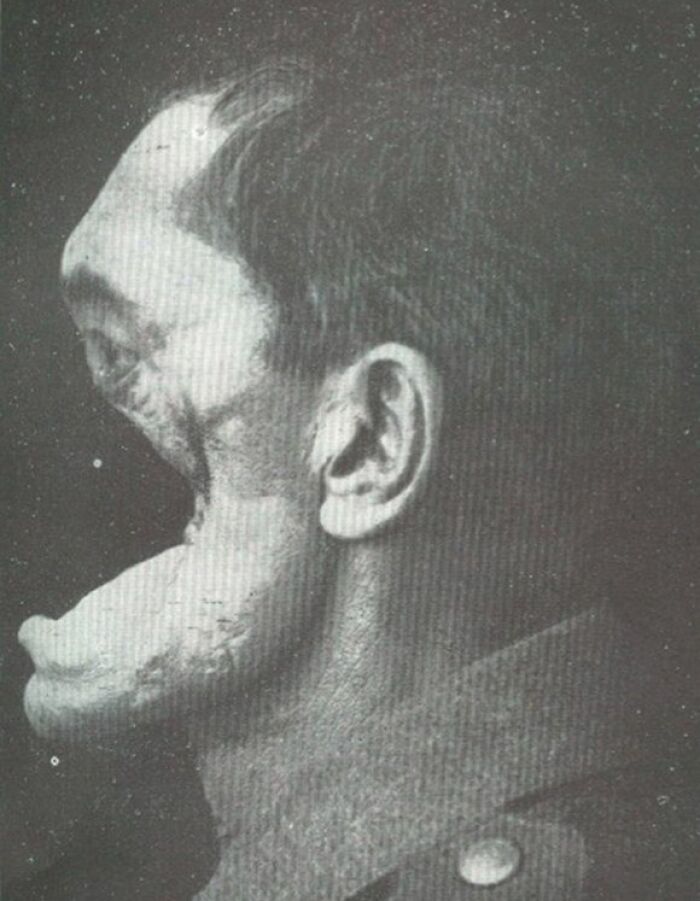 Black and white photo of a man with severe facial disfigurement, an incredibly creepy and unsettling image from the past.