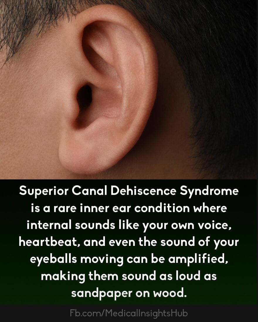 Close-up of a human ear with text explaining a rare inner ear condition related to curious medical facts and fingers containing no muscles.