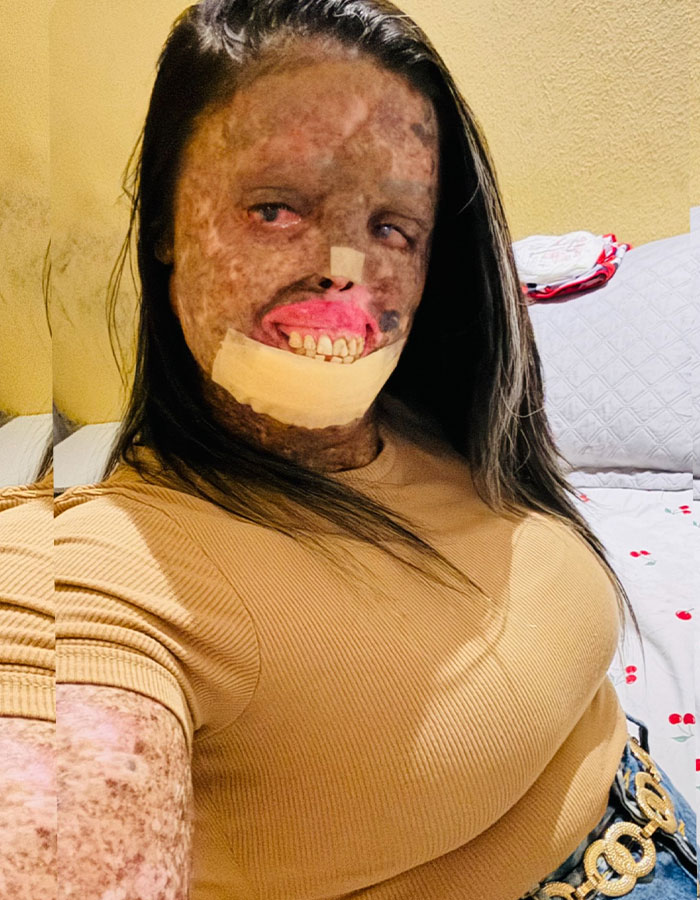 Woman with rare skin condition receiving treatment after online trolls criticized her for having a baby at home.