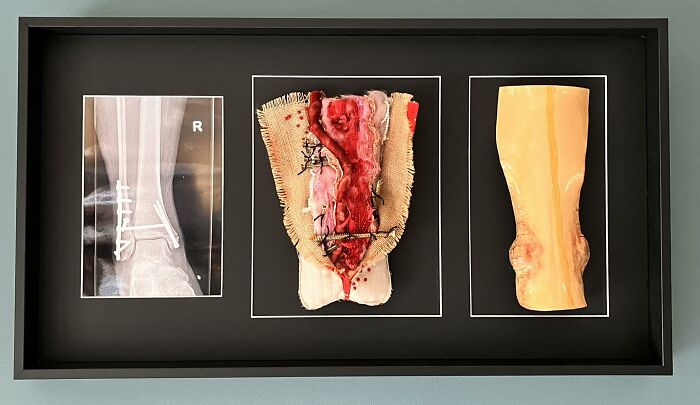 Triptych art piece showing an X-ray, a disturbing fabric DIY craft, and a molded leg sculpture in a black frame.