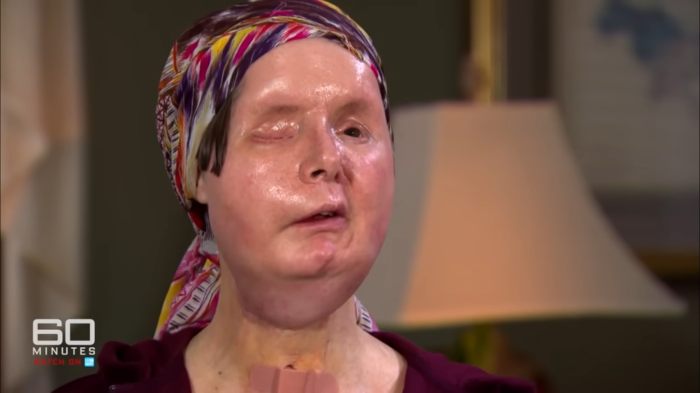 Woman whose face was torn apart by chimpanzee showing her appearance 16 years after face transplant interview setting