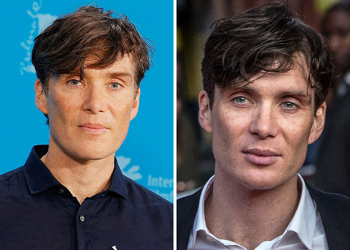 Actor con peculiaridades únicas en la piel y rostro, celebridad que acepta sus diferencias visibles con confianza.