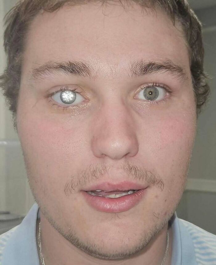 Close-up of a man showing an unusual eye condition, highlighting bizarre and rare health facts about nature and animals.