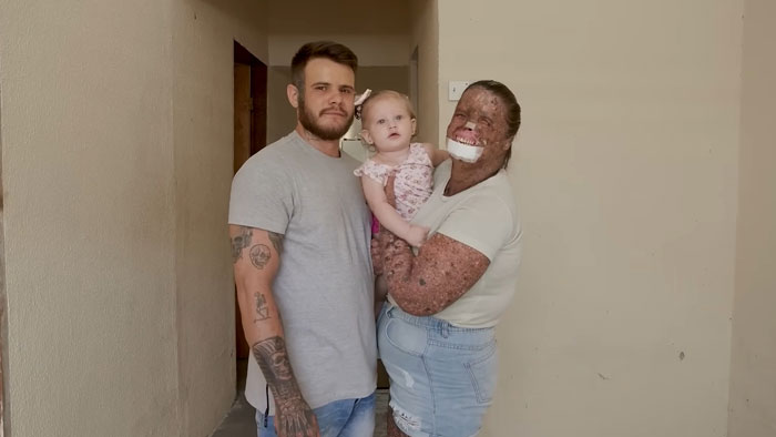 Mom with rare skin condition holding baby, standing next to partner in a hallway, showing togetherness and care.