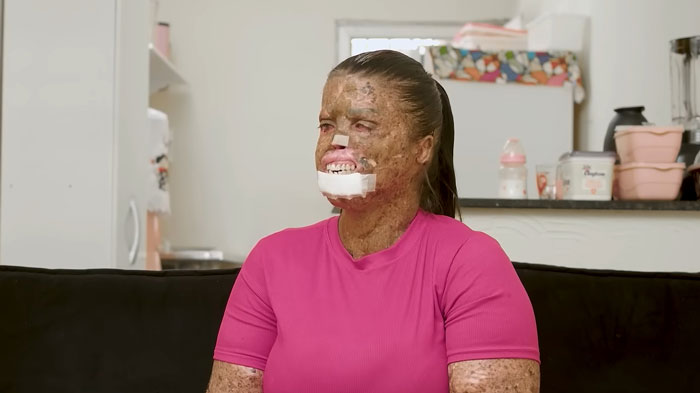 Mom with rare skin condition sitting indoors wearing a pink shirt, receiving treatment after facing online trolls.