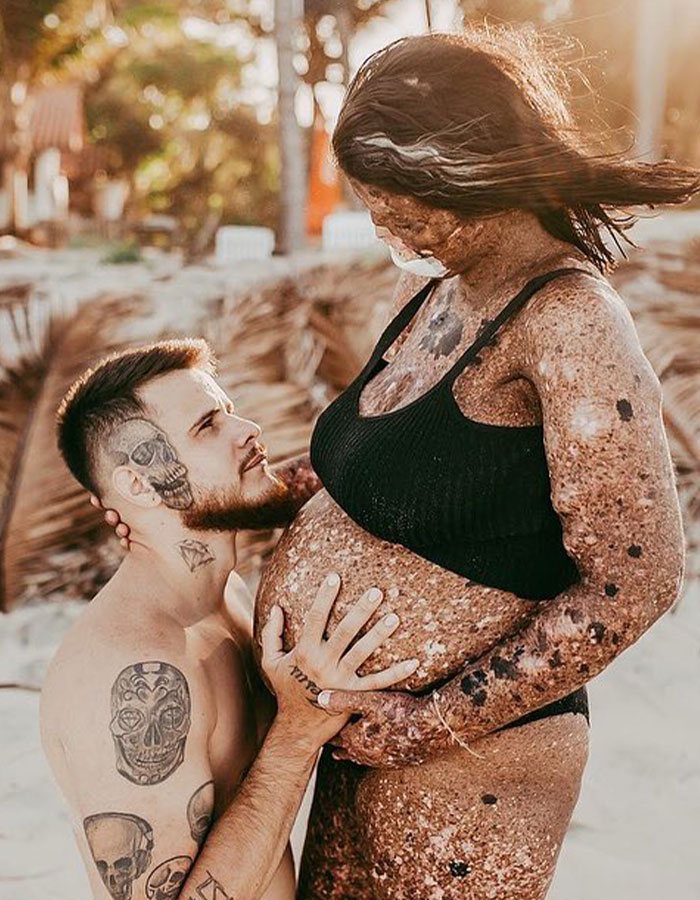 Pregnant mom with rare skin condition receives treatment after facing criticism from trolls for having a baby.