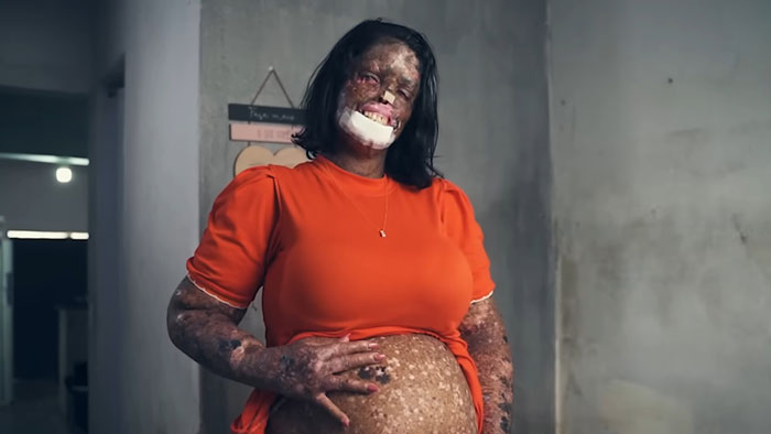 Pregnant mom with rare skin condition smiling and touching belly, receiving treatment after facing online trolls.