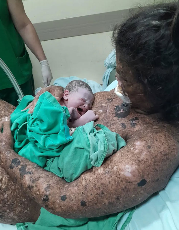 Mom with rare skin condition holding newborn baby after delivery in hospital, receiving care and treatment.