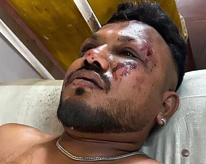 Sole survivor of Air India crash lying injured with visible bruises and wounds, performing a final act for his brother.
