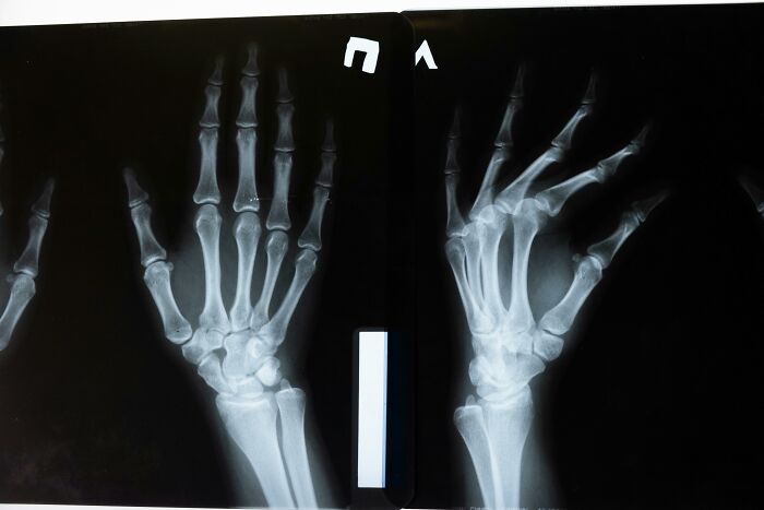 X-ray images of a human hand and wrist showing bones, highlighting bad things people life may experience physically.
