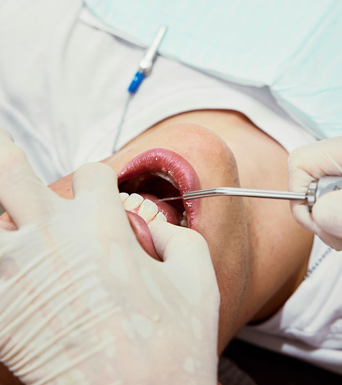 Close-up of dental treatment showing human body flaws with dentist using tools on a patient's open mouth.