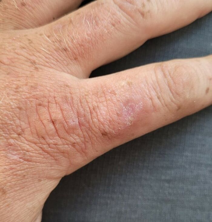 Close-up of a hand showing dry skin and damage around nails, illustrating nail biting and toenail biting habits.