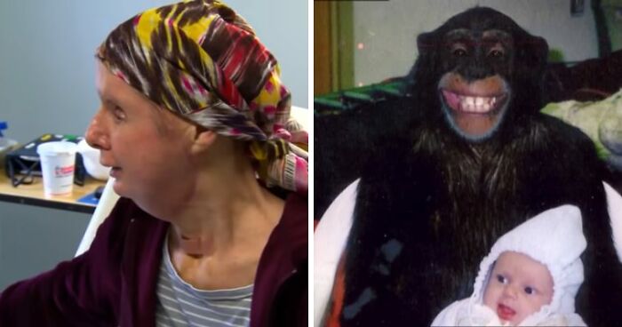 Woman Whose Face Was Torn Apart By Chimpanzee Reveals Her Appearance 16 Years After Face Transplant