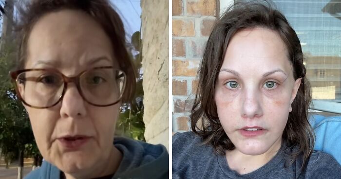 “I Still Don’t Recognize Myself”: Woman’s $15K Facelift Results Break The Internet