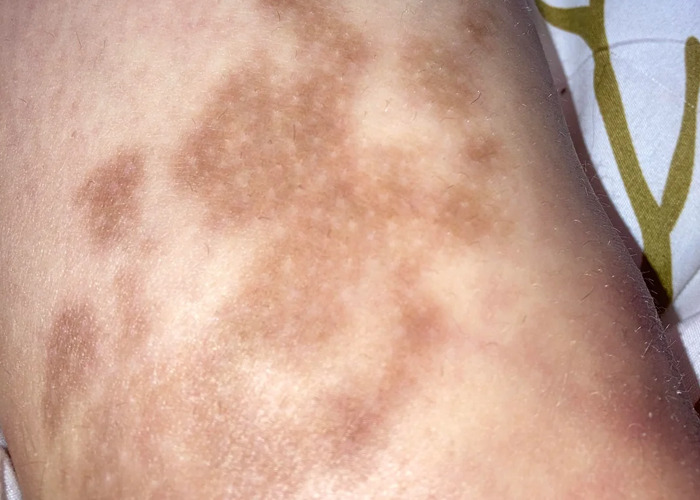 Close-up of skin with irregular brown patches, illustrating a bizarre medical skin case witnessed by healthcare professionals.