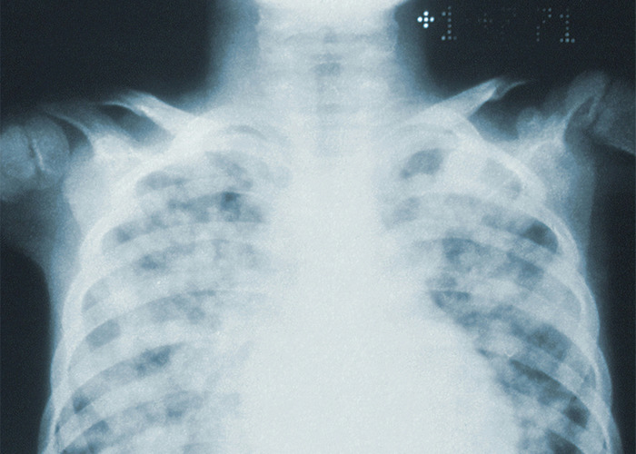 X-ray image of a human chest showing ribs and lungs, illustrating a bizarre medical case involving skin abnormalities.