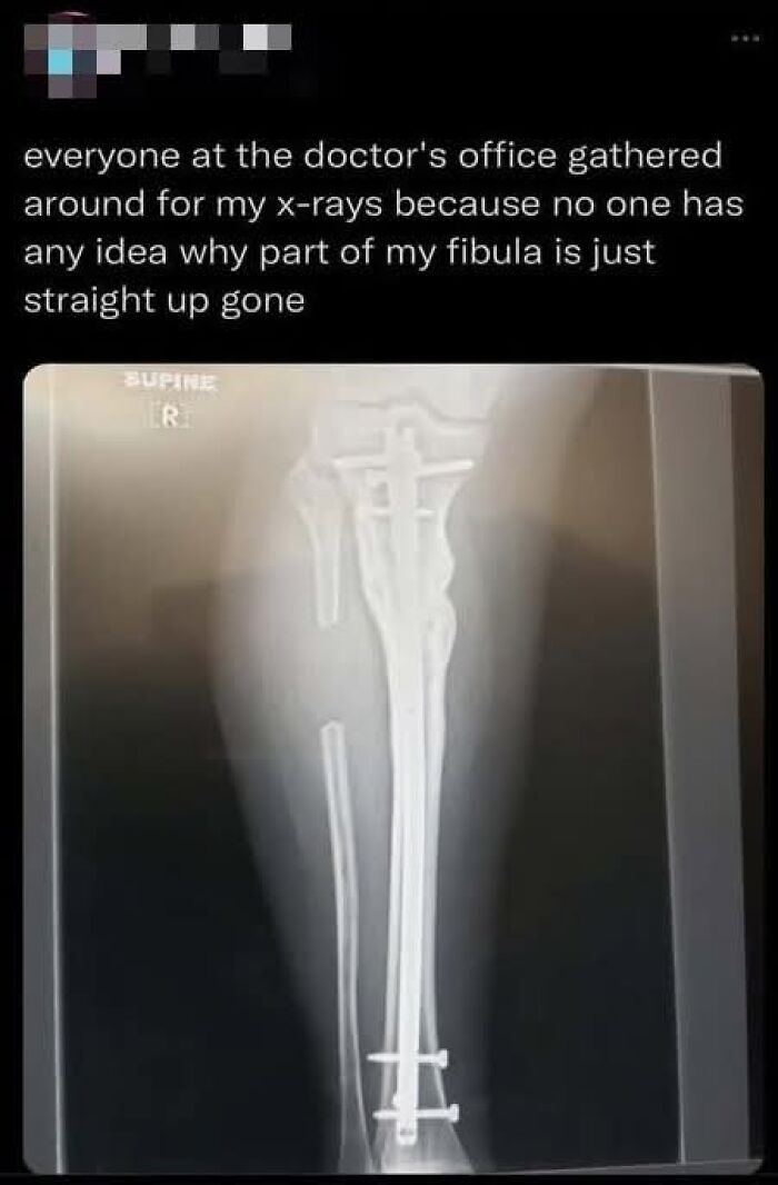 X-ray image showing broken fibula with metal rods and screws, paired with a funny meme about confused doctors.