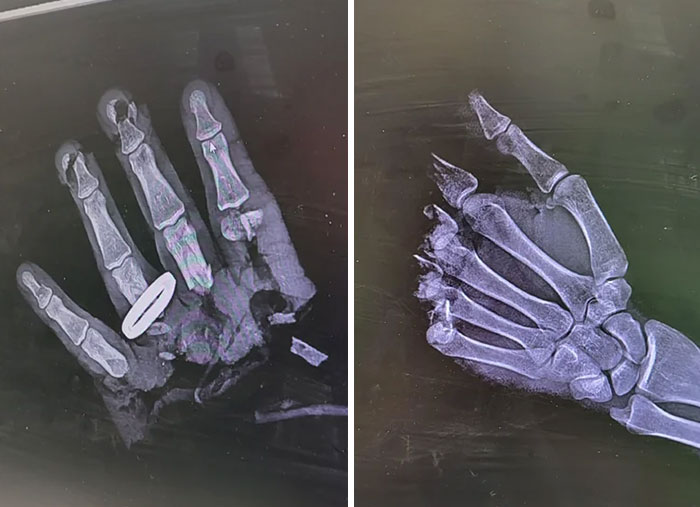 X-ray images showing a severely fractured hand with bone fragments and a foreign object, part of gory medical cases.