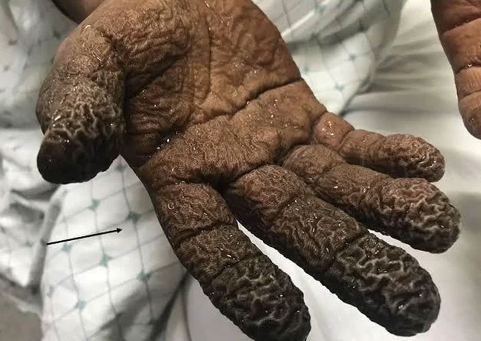 Severe medical case showing wrinkled, discolored fingers as an example of gory and interesting medical conditions.