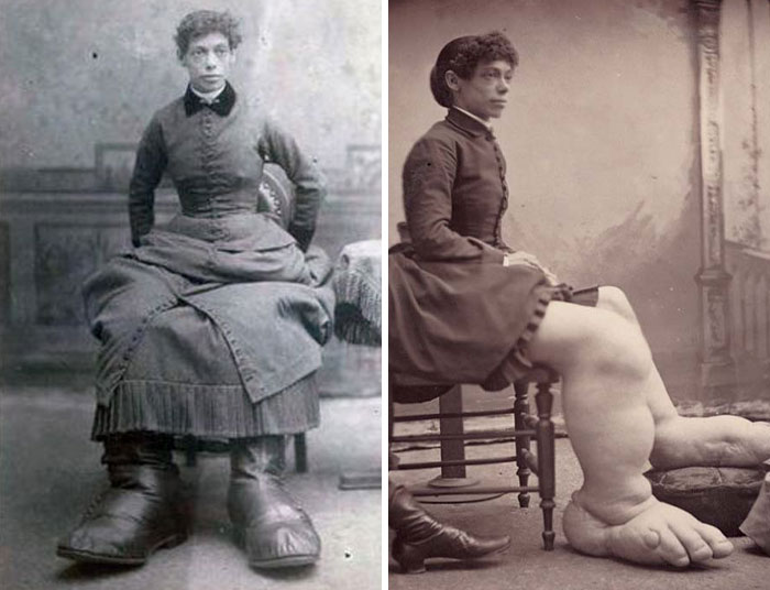 Victorian times photograph of a woman with unusually large feet seated in a vintage indoor setting.