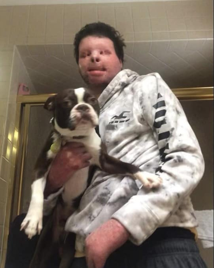 Man with new face transplant from 47-year-old donor holding a dog, showing recovery after a painful three-month coma. Man with new face transplant from 47-year-old donor holding a dog, showing recovery after a painful three-month coma.