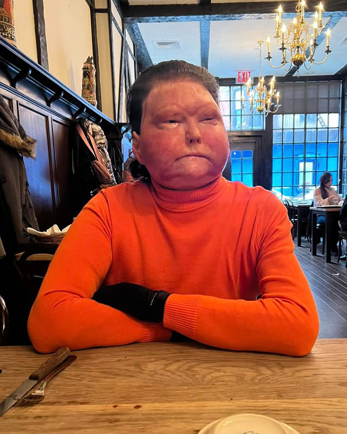 Man with new face transplanted from 47-year-old donor sitting at a table in a restaurant wearing an orange sweater. Man with new face transplanted from 47-year-old donor sitting at a table in a restaurant wearing an orange sweater.