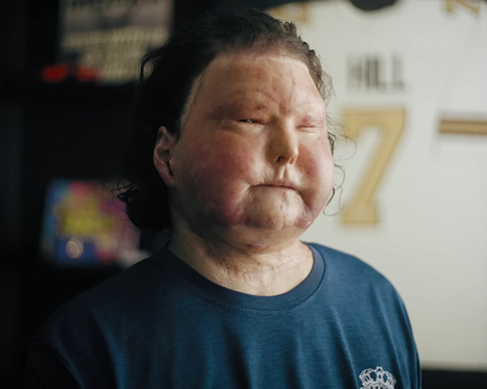 Man with new face transplanted from 47-year-old donor shares his experience after a painful 3-month coma. Man with new face transplanted from 47-year-old donor shares his experience after a painful 3-month coma.