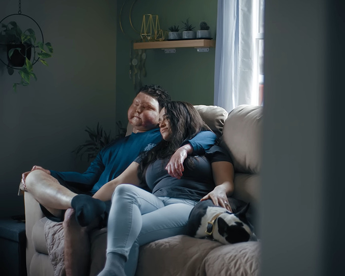 Man with new face transplanted from 47-year-old donor resting with partner on couch in cozy living room. Man with new face transplanted from 47-year-old donor resting with partner on couch in cozy living room.