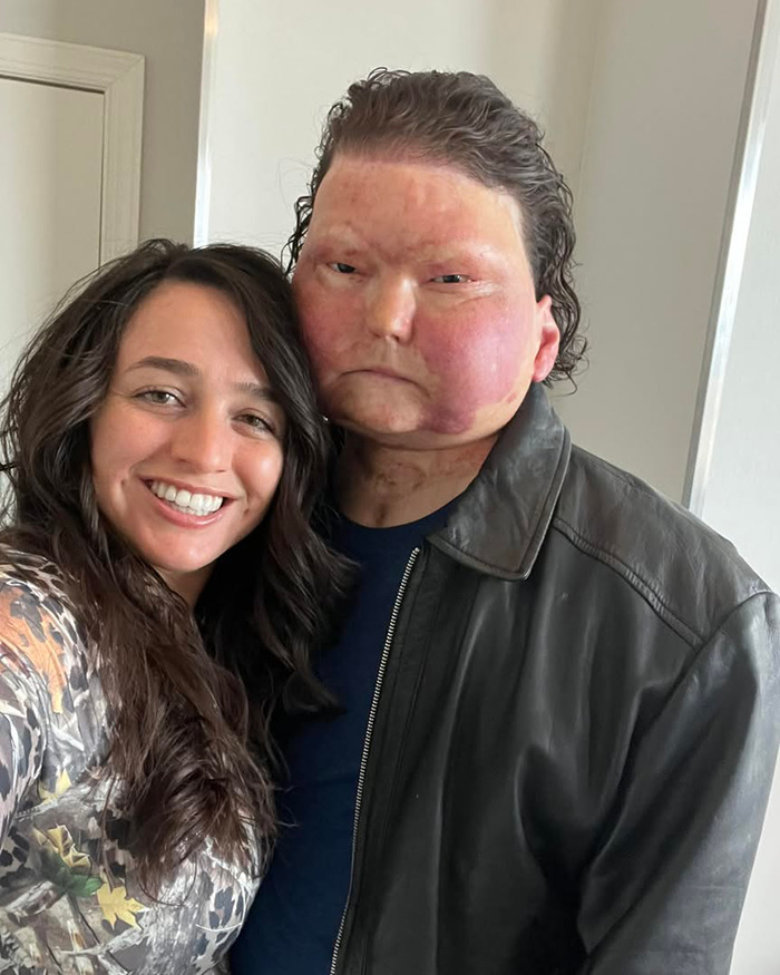 Man with new face transplant from 47-year-old donor standing next to smiling woman indoors. Man with new face transplant from 47-year-old donor standing next to smiling woman indoors.
