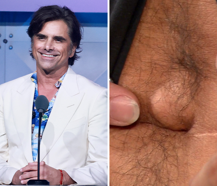 Actor smiling at a podium alongside a close-up of a rare celebrity body anomaly on hairy skin.
