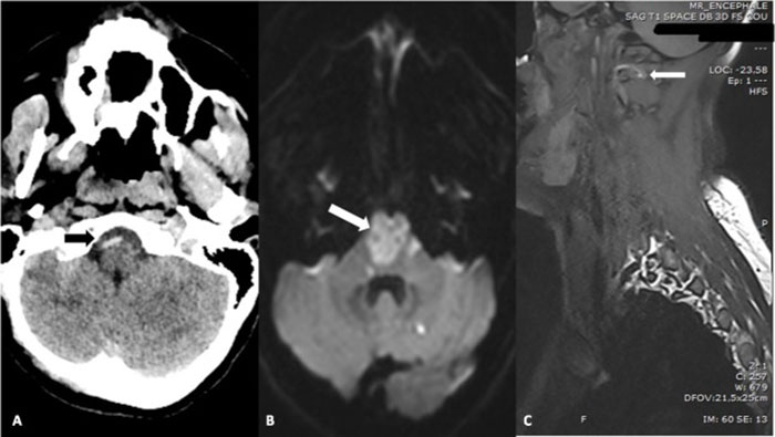 CT and MRI scans showing brainstem and cervical spine areas linked to neck pain and locked-in syndrome after chiropractic visit.