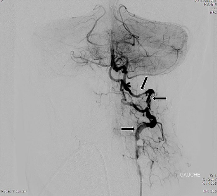 X-ray image of blood vessels in the neck highlighting issues related to chiropractor neck pain and locked-in syndrome.