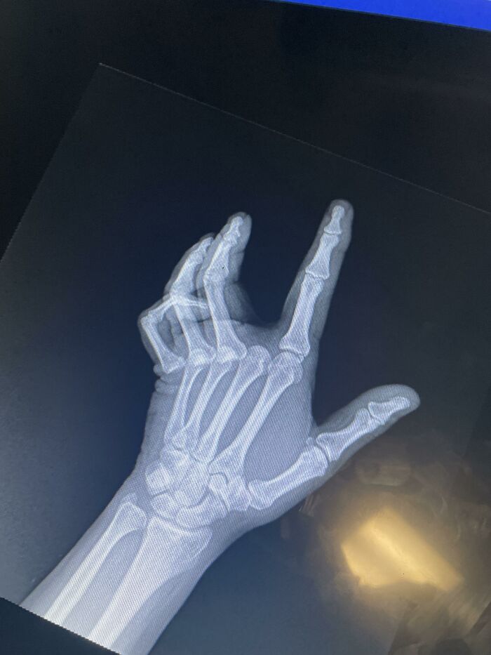 X-ray image of a hand showing two sets of overlapping fingers illustrating men doing dumb things humor concept.