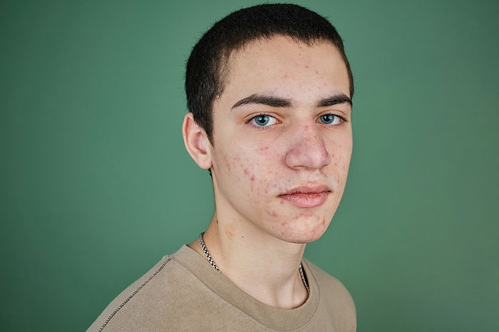 Teen boy with acne and short dark hair against green background, representing parents who disowned their children concept.