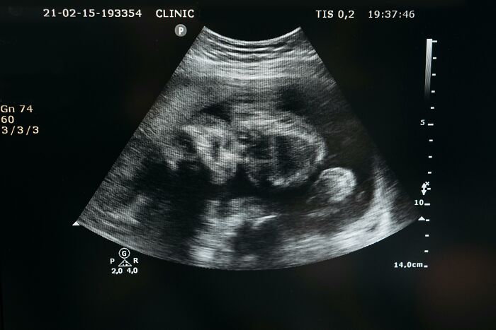 Ultrasound scan image showing a fetus, evoking unsettling and scary Wikipedia article themes.