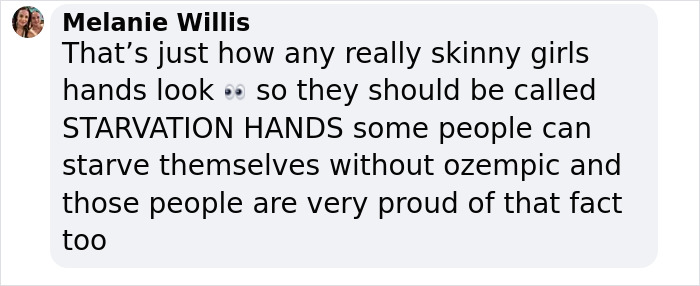 Screenshot of a social media comment discussing skinny girls’ hands and mentioning Ozempic hands side effect.