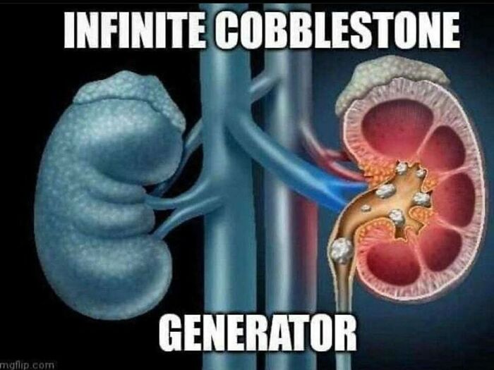 Illustration of kidneys showing kidney stones labeled as infinite cobblestone generator, a curious medical observation.