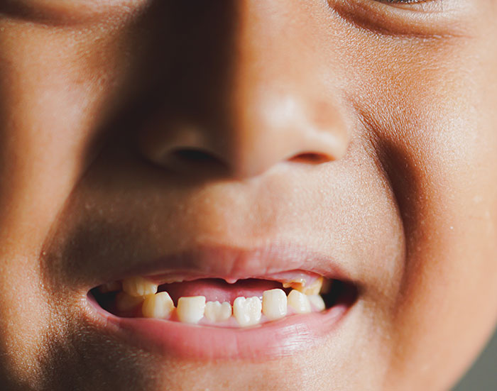 Close-up of a child's face with missing teeth illustrating kids lies that started off silly and got way too real.