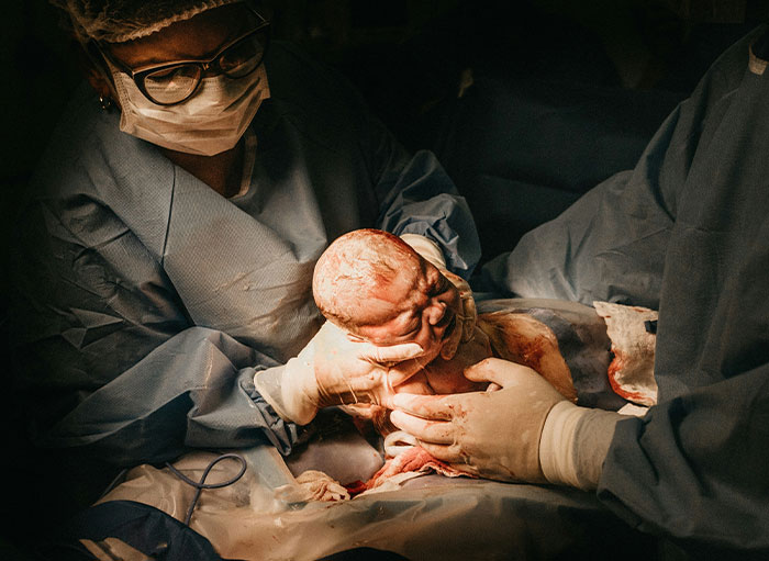 Surgeons in sterile gowns and gloves delivering a newborn, showcasing unique facts about the human body during birth.
