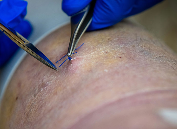 Surgeon in blue gloves stitching skin during a procedure revealing weirdest facts about the human body.